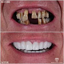 Smile Makeover Turkey Smile Makeover Dental Tattoo Removal Cream