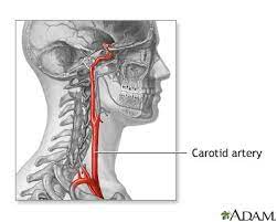 Many anatomical features add risk to surgery, and these include previous neck irradiation, a contralateral carotid occlusion or efficacy of embolic protection devices: Carotid Artery Anatomy Medlineplus Medical Encyclopedia Image