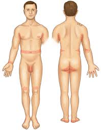 Image result for scabies in the groin area