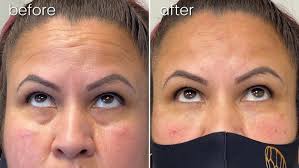 Facial Fillers Bakersfield, CA