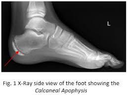 Image result for Calcaneal Apophysitis