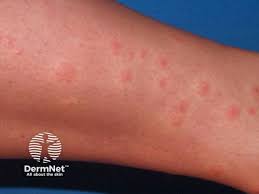 Image result for mite bites on humans