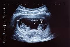 Can twins be detected at 6 weeks?
