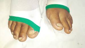Image result for Koilonychia feet