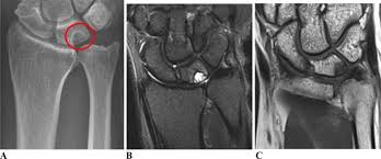 Ulnar Impaction Syndrome: A Case Series Investigating The Appropriate  Diagnosis, Management, And Post-Operative Considerations