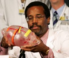 Conjoined twins occur once every 200,000 live births, according to the university of minnesota. Ben Carson S Surgeries Separated Twins Didn T Always Save Them The Boston Globe