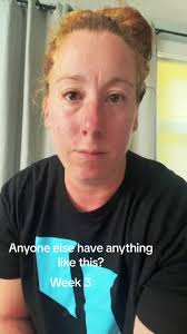 Sarah Breaking Out in Hives