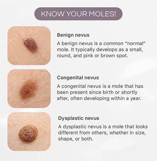 Michael K. Kim, M.D. - Safe and Effective Mole Removal Procedure for  Flawless Skin
