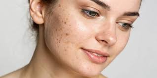 Image result for acne face