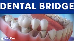 Dental Implants Vs Tooth Bridge Comparison C Youtube
