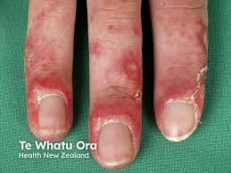 Image result for Chilblains