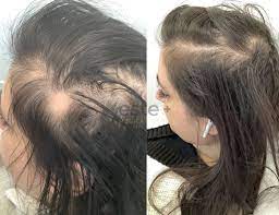 Alopecia Treatments | Treatments for Alopecia- Este