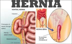 Pin Di Obat Hernia Tanpa Operasi