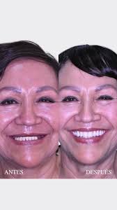 ¿Quieres recuperar tu capacidad de masticar correctamente y, al mismo  tiempo, estilizar tu rostro? 🦷✨, Los implantes dentales convencionales y  no convencionales son la clave para lograr una sonrisa ...