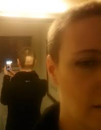 For many, hair grows back in 2 to 3 months. Alopecia From Radiation Brainreigns