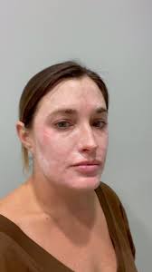 HQ•Hydroquinone layering protocol offered through ZO, 🔆Will absorb , 🔆Not  heavy or greasy, Say toodles to Melasma, 🫶🏽Remember there is no cure,  stay diligent with your skin care at home and in office ...