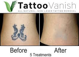 The article describes different ways of tattoo removal, their cost, and pain/ painless procedures involved. Tattoo Vanish The Best All Natural Non Laser Tattoo Removal Fast Eyebrow Tattoo Removal Near Me Tattoo Removal Cream