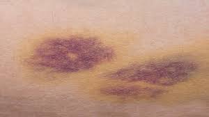 bacakta morarma belirtileri ve tedavisi