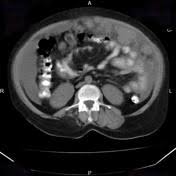 The aim of this study was to determine which computed tomography (ct) findings were useful in differentiating malignant peritoneal mesothelioma (mpm) and tuberculous peritonitis (tbp). Malignant Peritoneal Mesothelioma Radiology Reference Article Radiopaedia Org