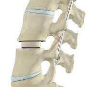 Transforaminal Lumbar Interbody Fusion (TLIF) Oklahoma City ...