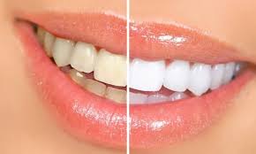 13 shade lighter | Laser Teeth Whitening in Delhi Geetanjali Dental