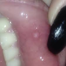 Meistens sind die lippen trocken und spröde. Was Mache Ich Gegen Gelblaschen An Der Lippe Blase Gel