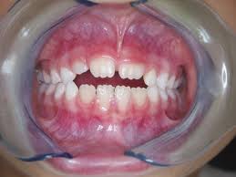 Heuten waren wir beim zahnarzt und die hat festgestellt, dass bereits der erste bleibende zahn durch ist und der. Luckenhalter Und Kinderprothesen Bei Zahnverlust Zwp Online Das Nachrichtenportal Fur Die Dentalbranche