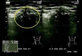 Pacientul are senzația că i se face o injecție, deci procedura nu e dureroasă și. Pagina 6 Tiroida Ro