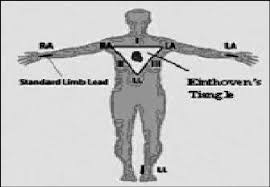 Meaning of bipolar lead medical term. The Placement Of The Bipolar Leads Download Scientific Diagram
