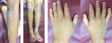 Drugs used to treat pityriasis rubra pilaris the following list of medications are in some way related to, or used in the treatment of this condition. Treatment Of Circumscribed Juvenile Type Of Pityriasis Rubra Pilaris With Calcipotriol A Case Report Journal Of Skin And Stem Cell Full Text