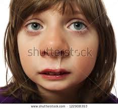 runny nose - cold - ill little girl - stock photo. Save to a Lightbox ▼. Please Login... To organize photos in lightboxes you must first register or login. - stock-photo-runny-nose-cold-ill-little-girl-122908393