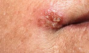 It is the common disease as a quarter of unfortunately, the specific treatments for herpes are not still unknown. Experts Reveal A Cure For Sexually Transmitted Infection Herpes Could Be On The Horizon Express Co Uk