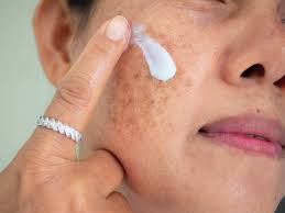Image result for Melasma