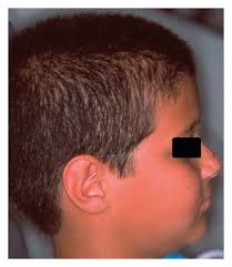 Phenotypic Features and Salivary Parameters in Patients with Ectodermal  Dysplasia: Report of Three Cases