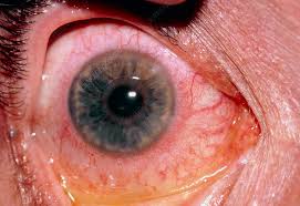 Image result for Ciliary Flush