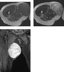 Image result for Leiomyosarcoma