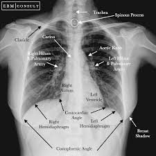 The chest wall is formed from the sternum anteriorly, 12 pairs of ribs, costal cartilages and intercostal muscles laterally, and the thoracic vertebrae posteriorly. Radiology Chest Xray Normal