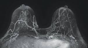Your doctor and radiographer make sure the benefits of having the. Better Techniques Coming To Breast Cancer Screening The Asco Post