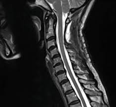 You have 12 vertebrae in your upper and middle back. Spinal Pain Symptoms Diagnosis And Treatments