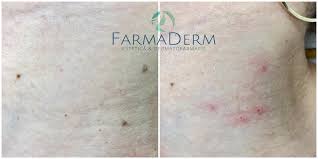 Verucile (sau negii) sunt produse, de obicei, de o infectie virala cu. Indepartare Papiloame Simplu Si Usor Oradea Farmaderm