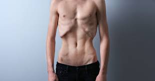 What It's Like To Be A Man Struggling With An Eating Disorder | By A Plus |  Medium