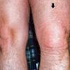 Being able to fully straighten the knee). 1