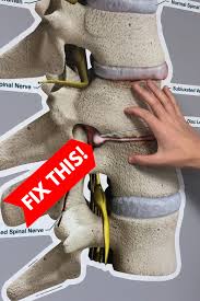 How To Fix A Bulging Disc In Your Lower Back Relief In Seconds Bulging Disc Herniated Disc Exercise Herniated Disc Lower Back