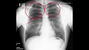 Nov 16, 2020 · a pneumothorax is defined as a collection of air outside the lung but within the pleural cavity. Pneumothorax Radiology In Two Minutes Youtube