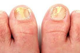 Jika terus dibiarkan, kuku tidak hanya berwarna kuning, tapi juga menjadi tebal. Apa Saja Penyebab Kuku Kuning Lifestyle Bisnis Com