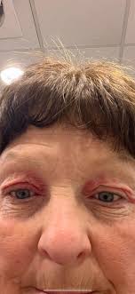 How To Treat Droopy Eyelids Naturally… The Results Are Amazing!