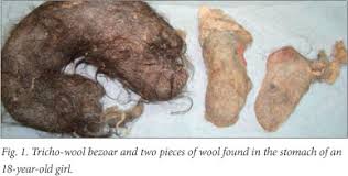 Image result for Bezoar