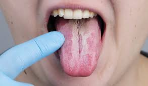 Image result for white cancer on tongue)