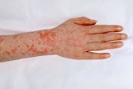 Image result for Scarlet Fever