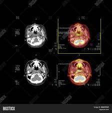 Pet scans are most commonly used to detect: Pet Ct Scan Image Image Photo Free Trial Bigstock